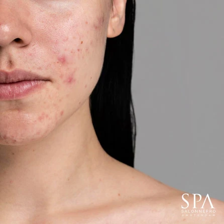 Acne behandeling Peg's Beautysalon Zevenaar